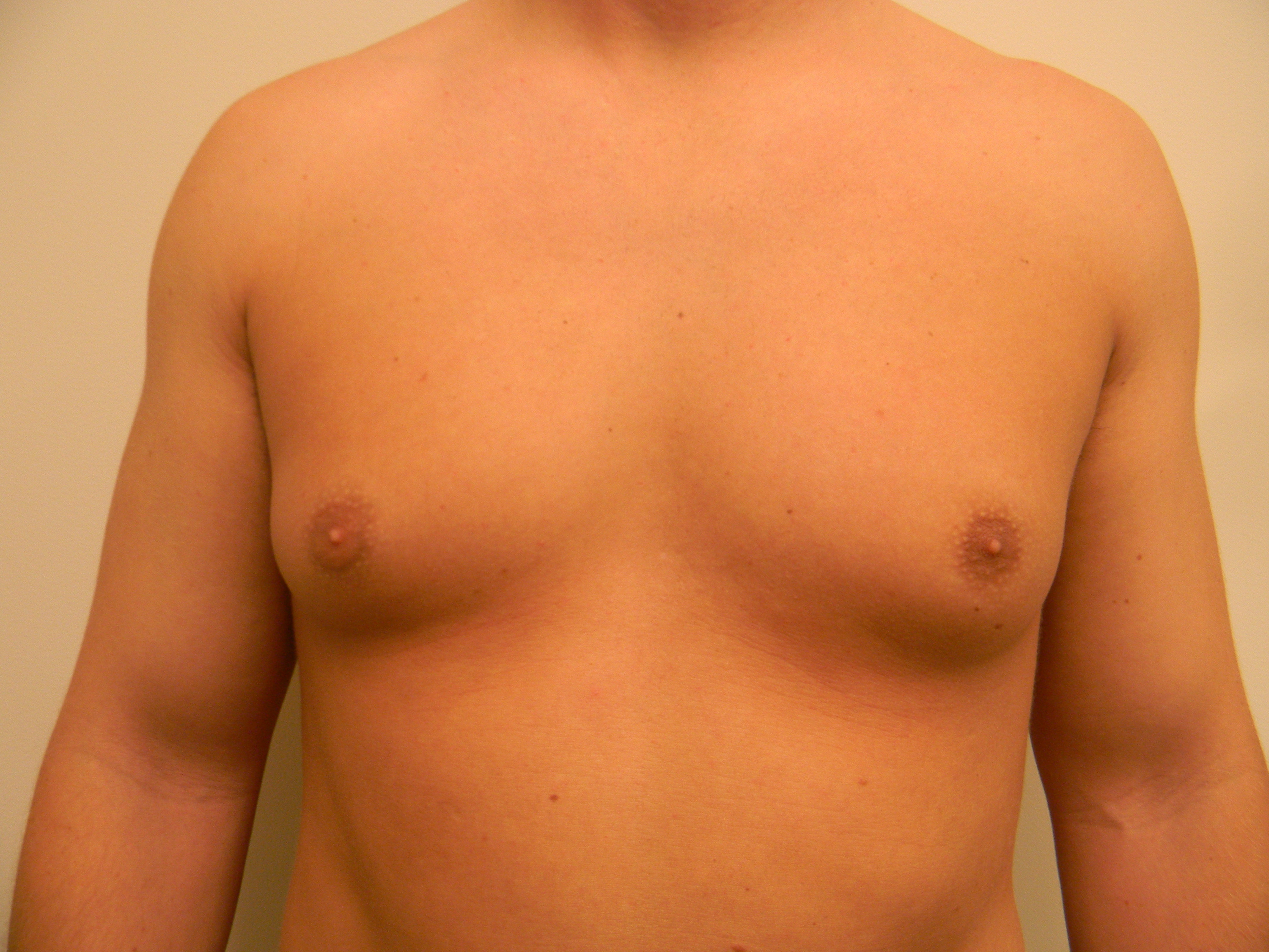 увеличенный сосок груди у мужчин фото 70