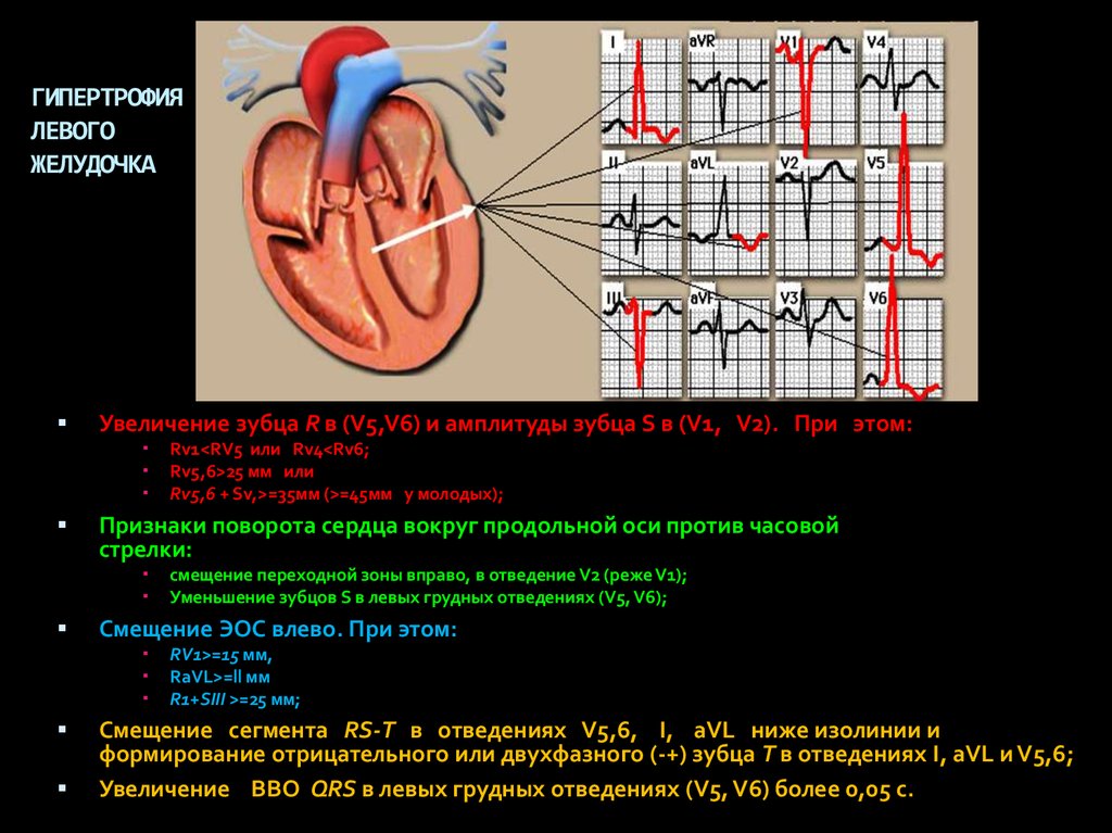 Миокард правого желудочка сердца. Зубец r при гипертрофии левого желудочка сердца. ГЛЖ левого желудочка сердце. Гипертрофия желудочков сердца — сердце.