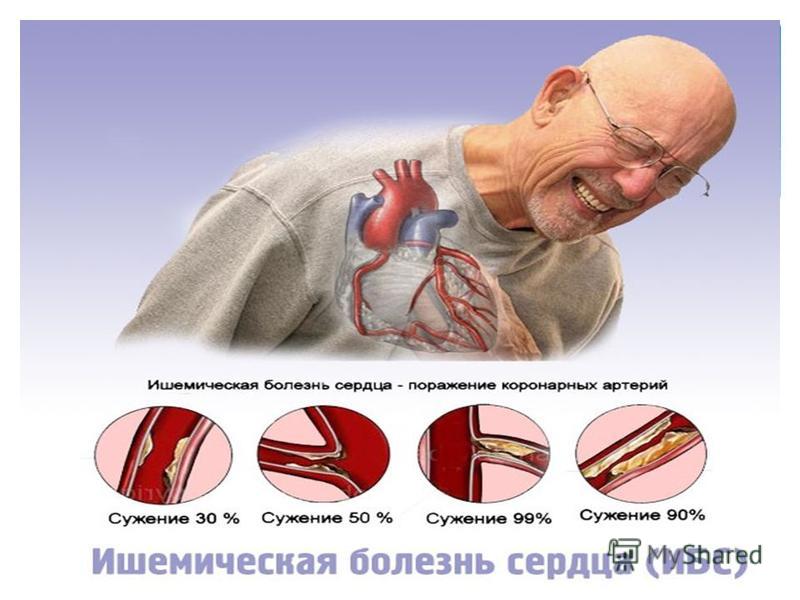 Ишемия симптомы у мужчин. ИБС стенокардия инфаркт миокарда. Коронарная ишемия сердца. Ишемическая болезнь сердца презентация. ИБС заболевания сердца.