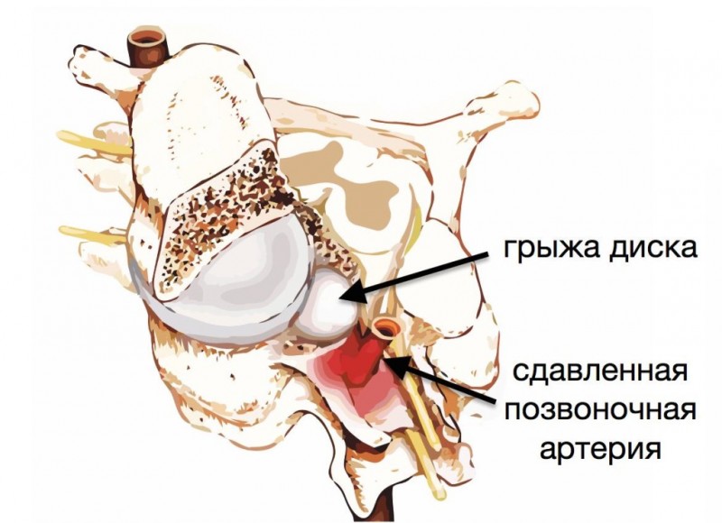 Спондилоартроз шейного отдела позвоночника что это такое