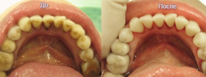 Санация полости рта – что это такое и зачем это нужно? санация ротовой полости перед имплантацией зубов