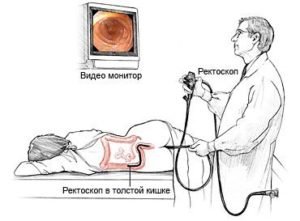 Ректороманоскопия (ректоскопия) кишечника: что это такое, как делается, подготовка к исследованию пациента