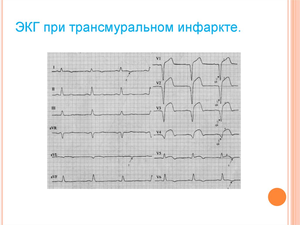 Трансмуральный инфаркт миокарда прогноз — сердце
