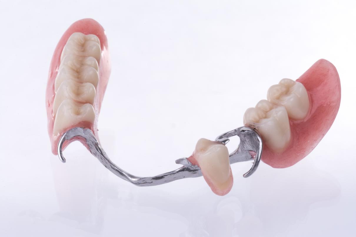 Основные плюсы и минусы бюгельного протезирования зубов