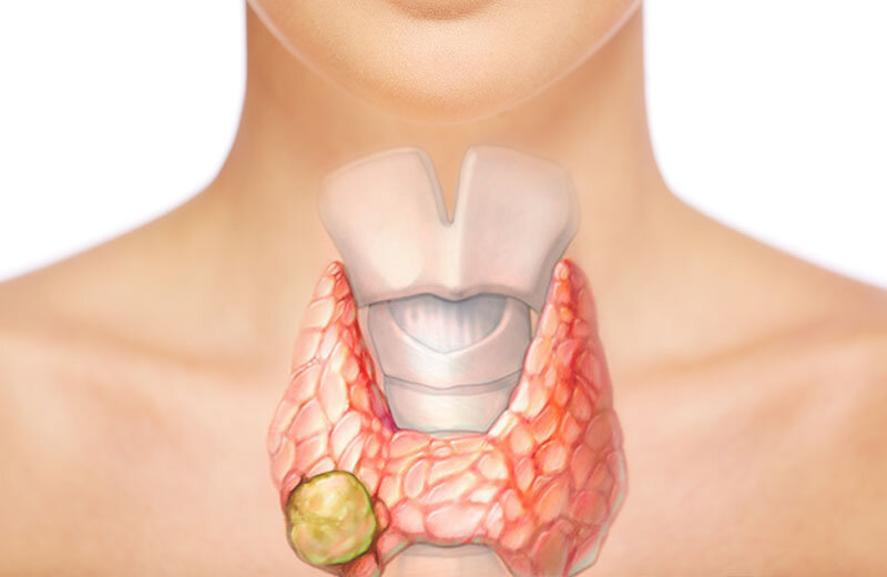 19 тревожных признаков проблем с щитовидной щелезой