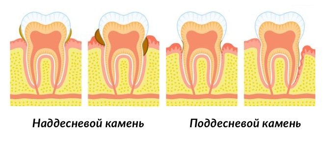 Как выглядит зубной камень и причины его появления фото