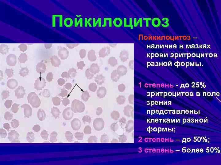 Пойкилоцитоз в общем анализе крови – причины развития, особенности заболевания