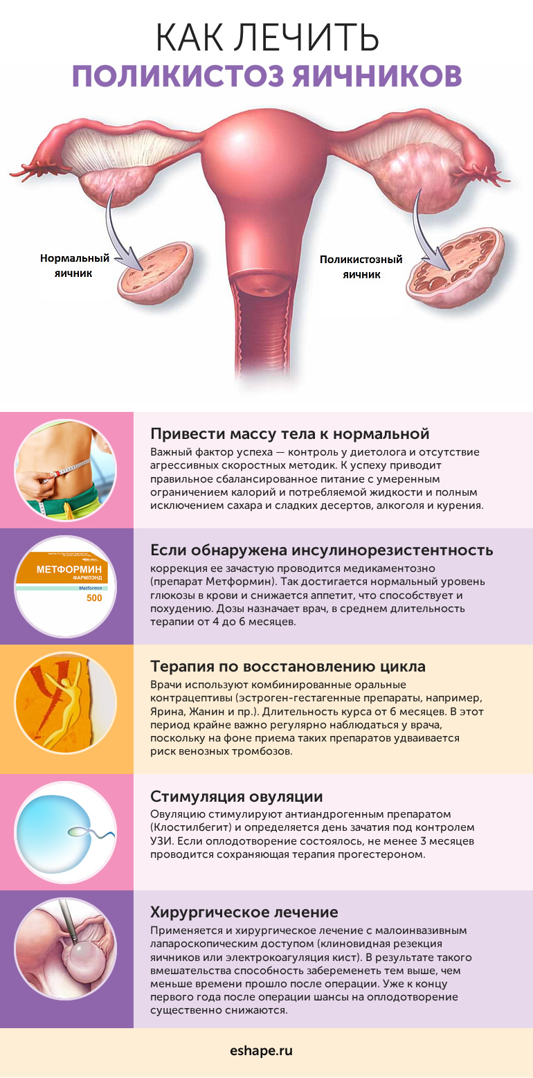 Что такое поликистоз яичников или спкя: симтомы, причины и лечение