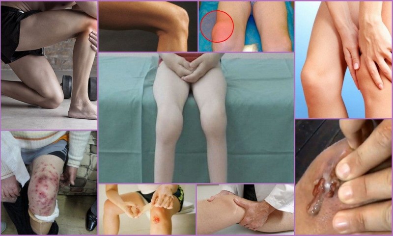 Чем опасен синовит коленного сустава? причины, симптомы, последствия патологии. методы лечения