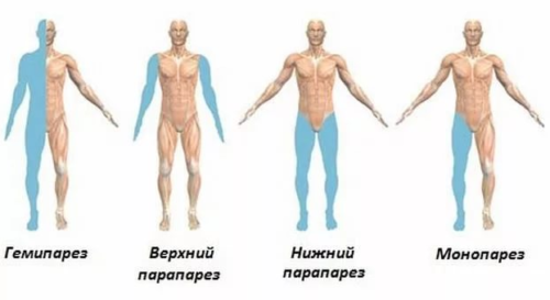 Парез конечностей: что это такое, причины, симптомы и способы лечения - московский центр остеопатии