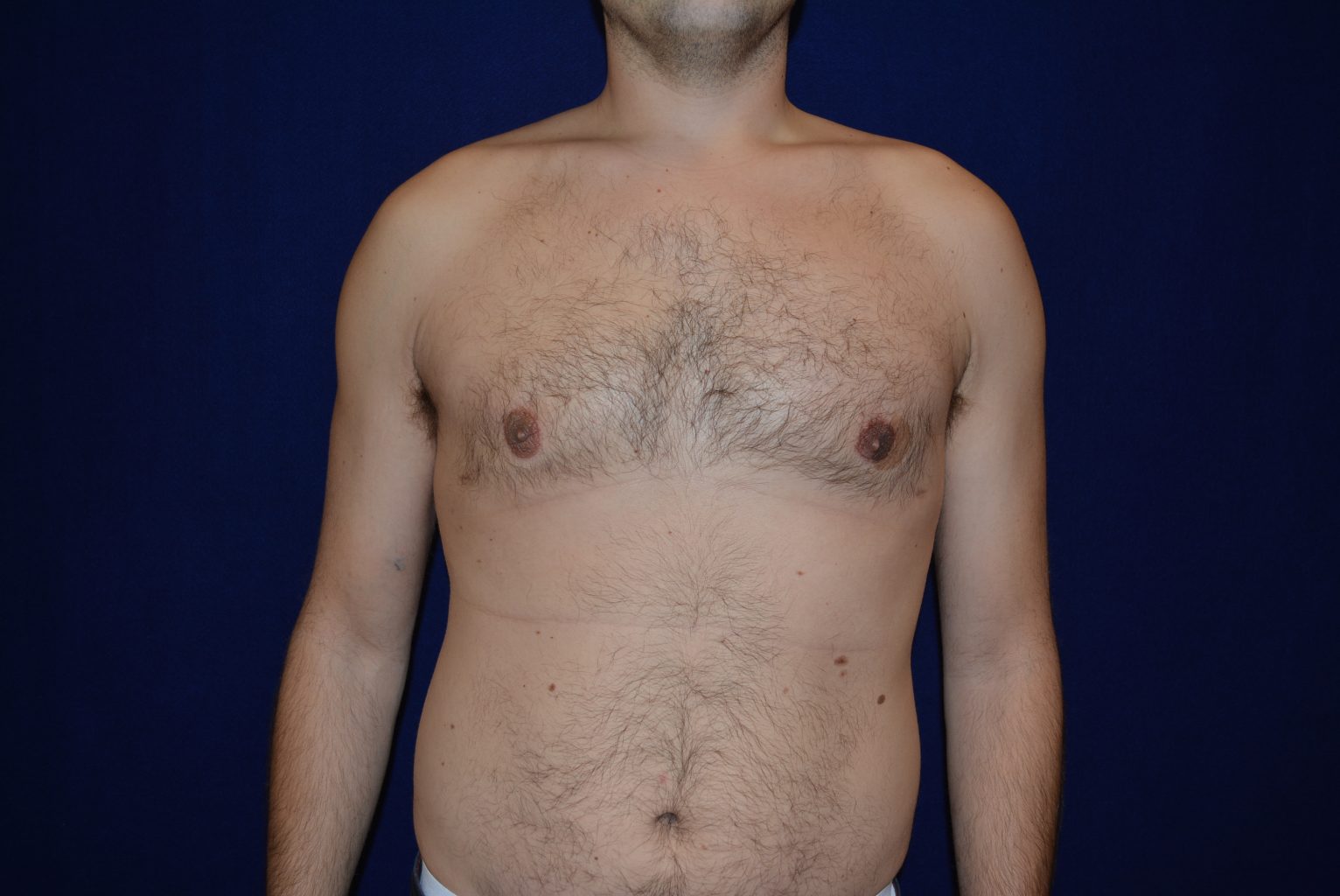 асимметрия груди у мужчин фото 93