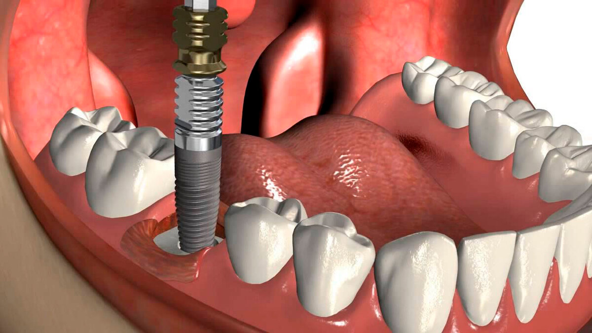 Что такое имплантация зубов — стоматология «эксперт»