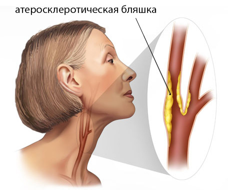 Что такое атеросклероз брахиоцефальных артерий и какой прогноз на жизнь?