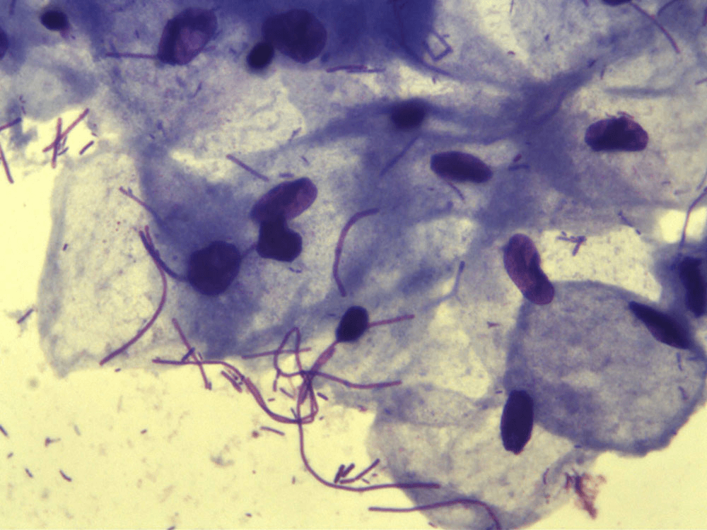 Enterococcus faecalis у мужчин: что это такое, норма содержания в мазке, моче, сперме, диагностика, лечение