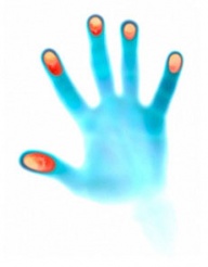 Что такое панариций пальцев рук и ног, виды лечения у детей и взрослых