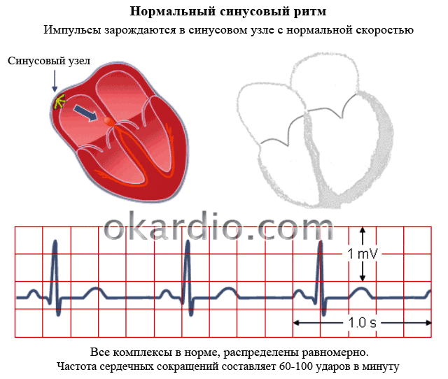 Синусовая брадикардия сердца: что это такое, причины, лечение и прогноз