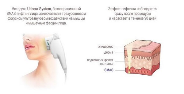 Как выбрать лифтинг-процедуру? лучшие способы подтяжки кожи