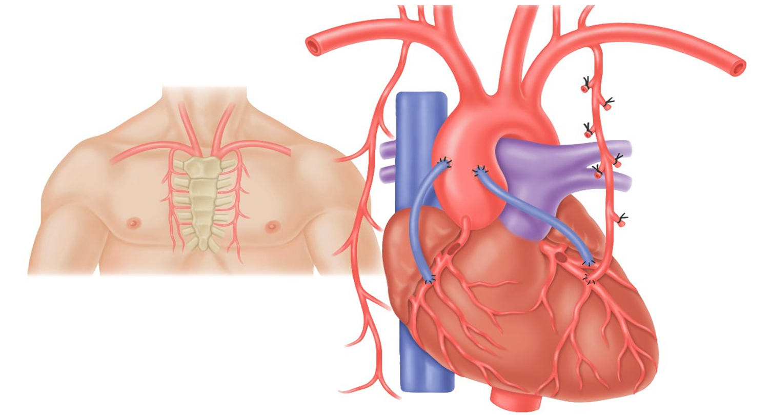 Что такое коронарное шунтирование сердца и как оно проводится?