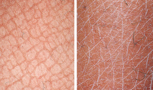 Ихтиоз кожи: что такое, причины заболевания, лечение в домашних условиях | kazandoctor.ru