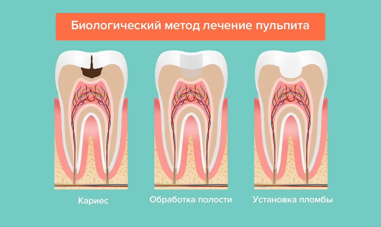 Пульпа зуба – состав, строение и функции пульпы