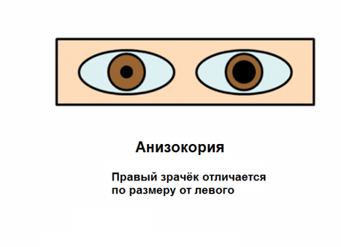 Анизокория
