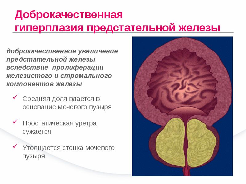 10 фактов, которые нужно знать о гиперплазии предстательной железы – москва 24, 30.03.2016