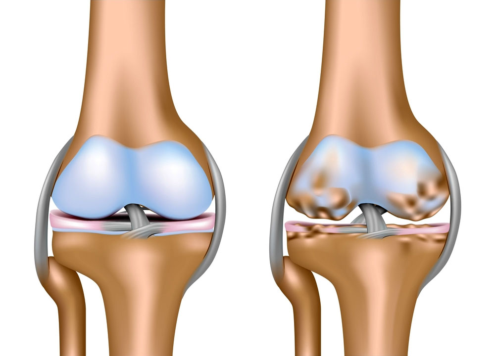 Гонартроз коленного сустава 2 степени: симптомы и лечение