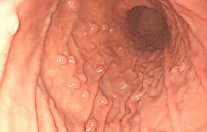 Какие симптомы проявления полипа (полипоза) кишечника и в ободочной кишке у взрослых