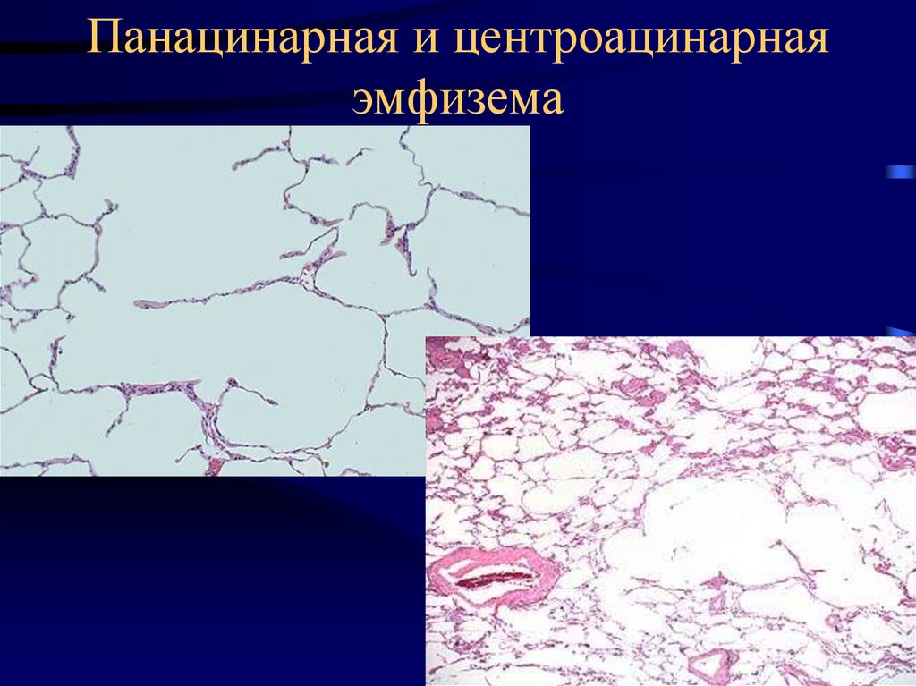 Парасептальная эмфизема легких что это такое | wine & water