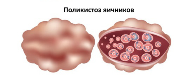 Симптомы, причины и лечение поликистоза яичников
