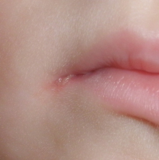Заеды в уголках рта: причины и лечение