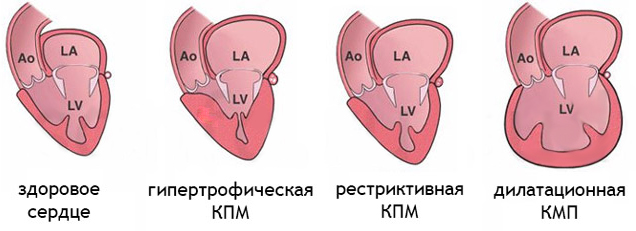 Кардиомегалия (гипертрофия сердца)