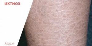 Ихтиоз кожи: лечение, фото с описанием симптомов и причины