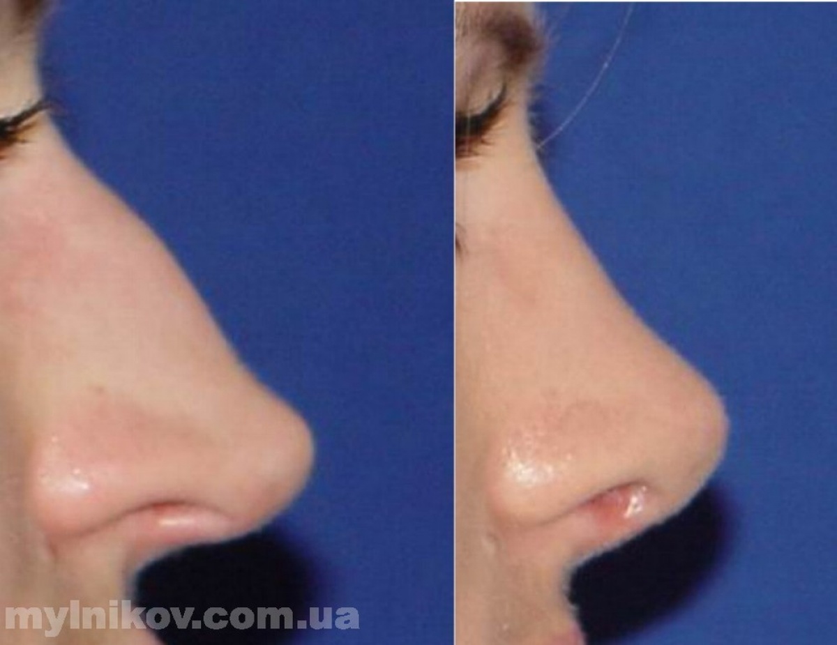 Пластика носа (перегородки носа)