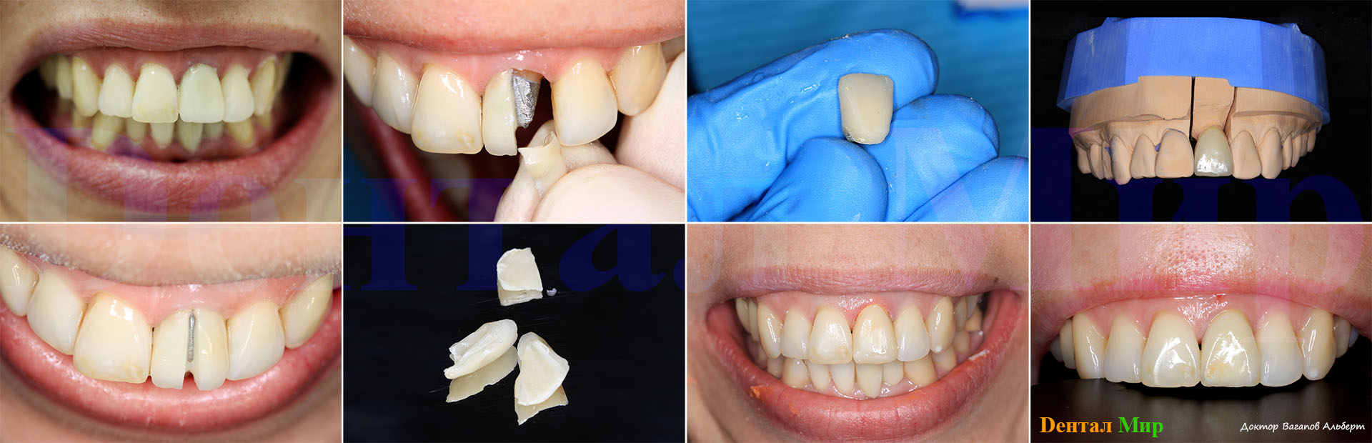 Как делают и ставят коронку на зуб: больно ли, этапы установки, процесс подготовки зуба