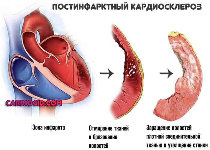 Причины митральной регургитации 1-4 степени, как выявить проблему и способы лечения