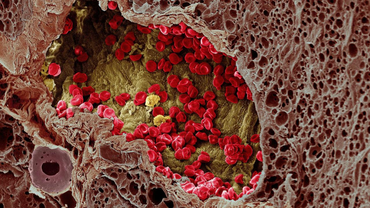 Онкология что это. Опухолевые клетки гистология. Базальноклеточная папиллома гистология. Гистология раковых клеток. Клетка меланомы под микроскопом.