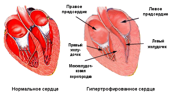 Гипертоническая болезнь (гипертония)