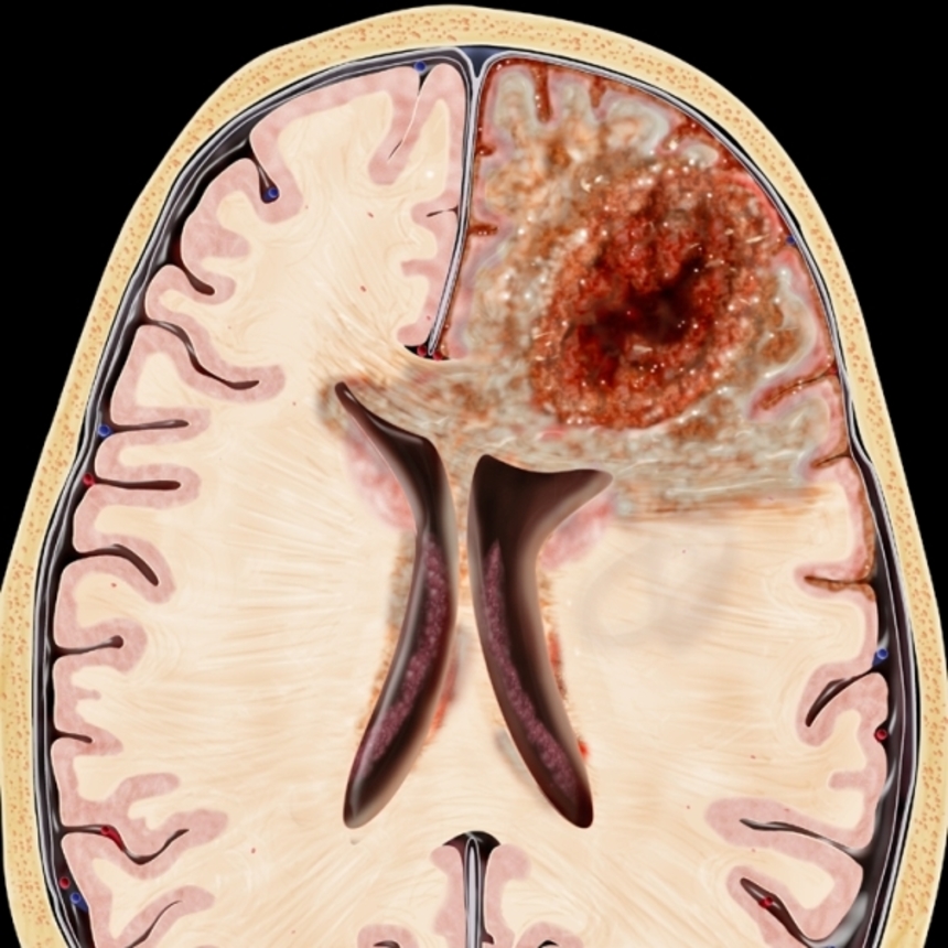 Глиобластома головного мозга: степени развития, мкб 10, фото, причины, симптомы и лечение опухоли