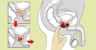 Полезен ли массаж простаты, техника выполнения