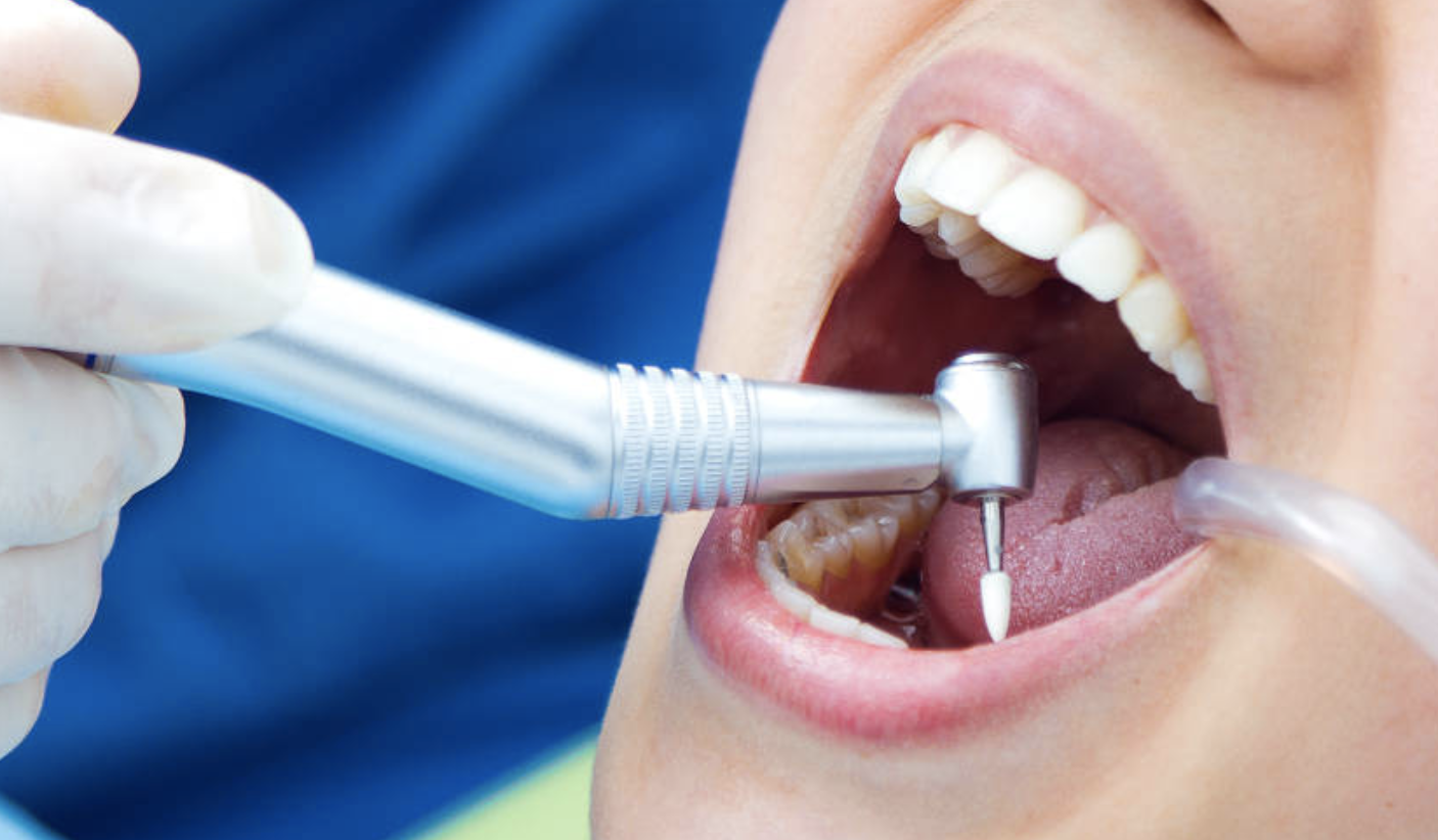 Что такое и зачем проводится полная санация полости рта