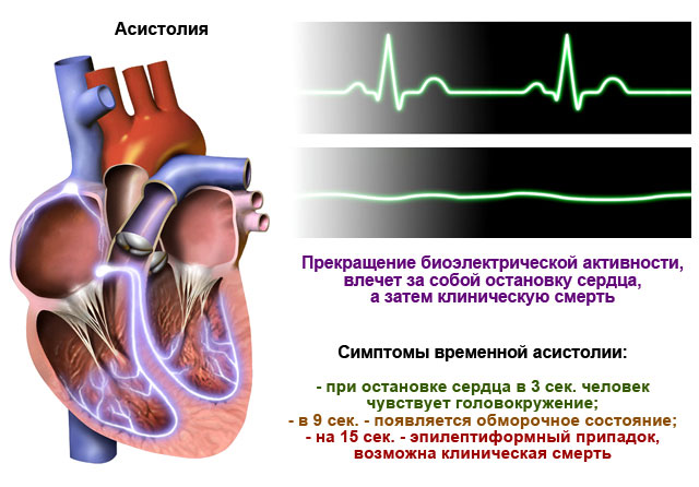 Экстрасистолия сердца: что это такое, причины, симптомы и лечение