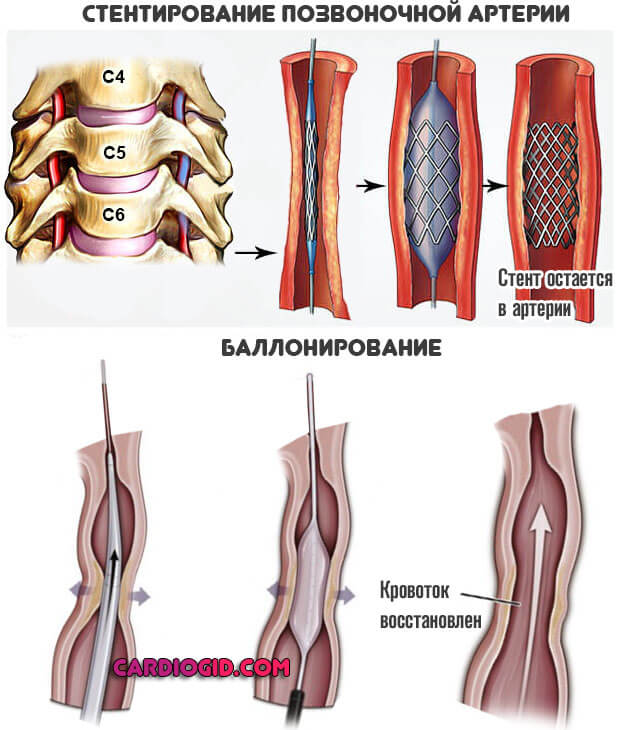 Что такое гипоплазия левой позвоночной артерии?