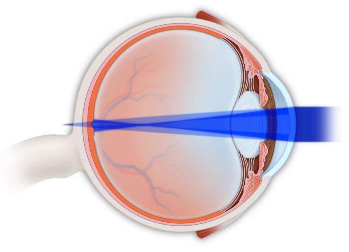 3 простые операции при астигматизме глаз