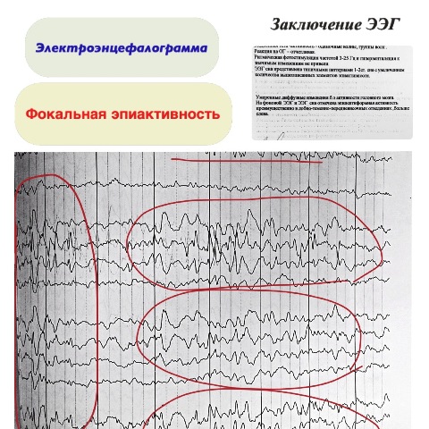 Расшифровка показателей электроэнцефалограммы (ээг) головного мозга