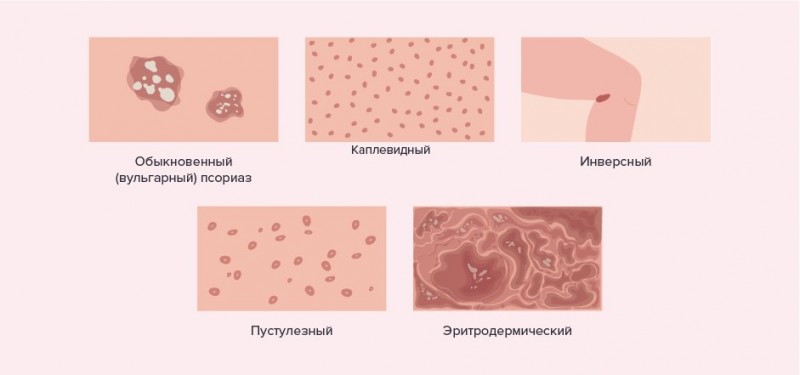 Как распознать псориаз? что это за болезнь? почему болеет кожа?