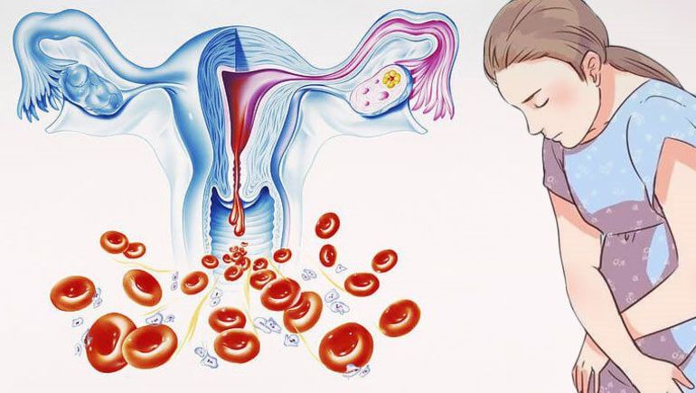 Метроррагия: что это такое, характеристика нмц (нарушения менструального цикла) по ее типу