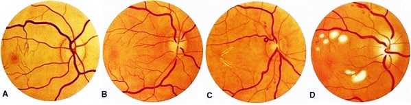 Как лечить гипертоническую ангиопатию сосудов сетчатки глаза и какие ее признаки
