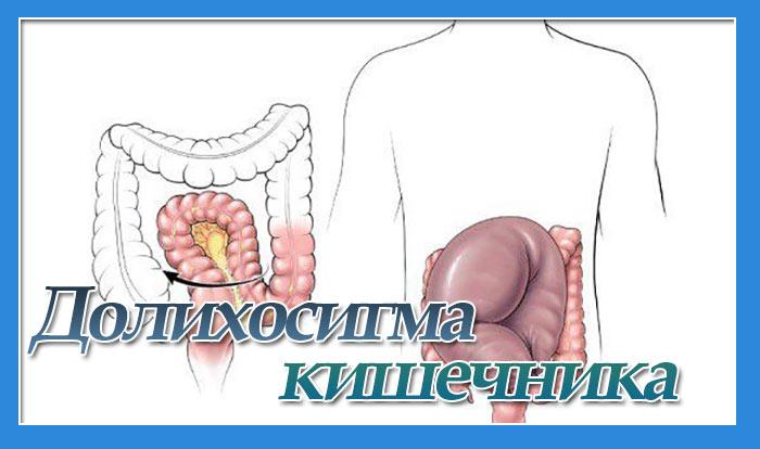 Долихосигма кишечника у взрослых: симптомы и лечение