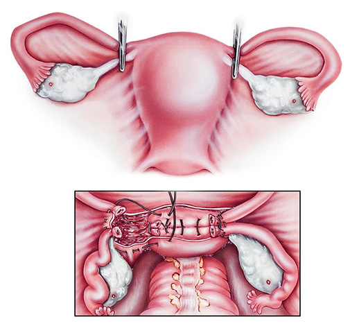 Лапароскопическая гистерэктомия - методы гистерэктомии матки, проведение лапароскопии в москве